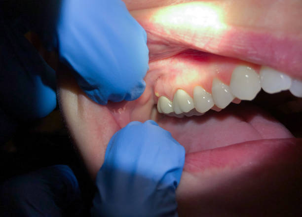 Best Emergency Wisdom Tooth Extraction in Secy, AR